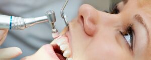 Samsun Diş Taşı Temizliği Dişe Zarar Verir mi?