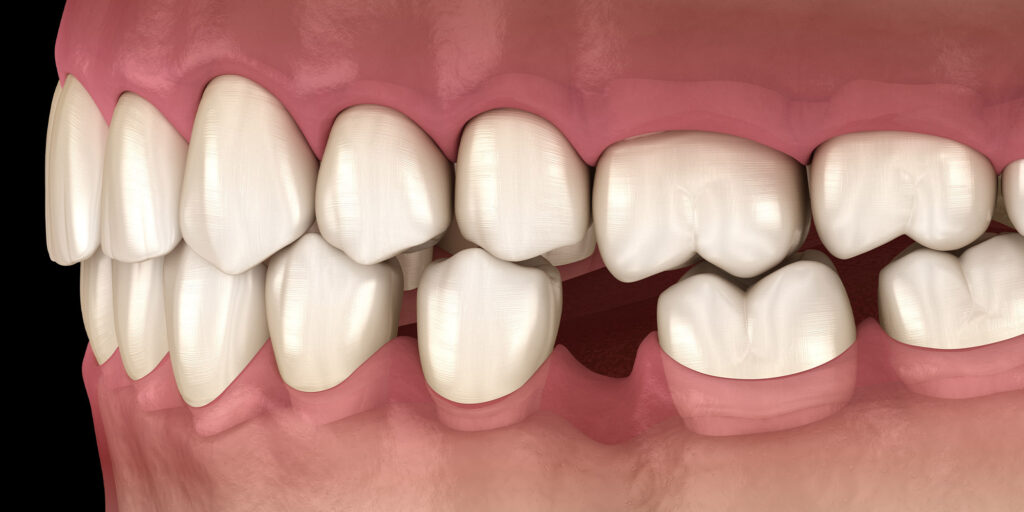 Diş Eti Çekilmesi Nedir, Nasıl Tedavi Edilir?
