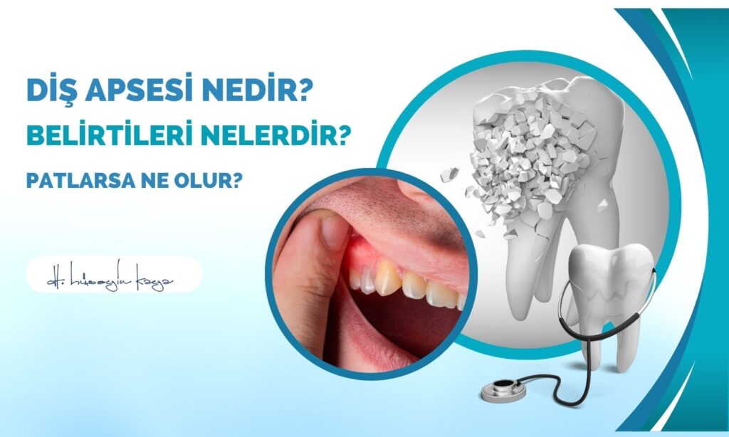 Diş Apsesi Nedir? Belirtileri Nelerdir? Patlarsa Ne Olur?