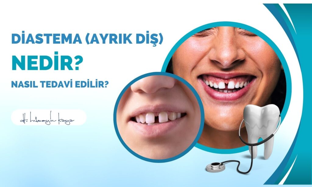 Diastema (Ayrık Diş) Nedir? Nasıl Tedavi Edilir?