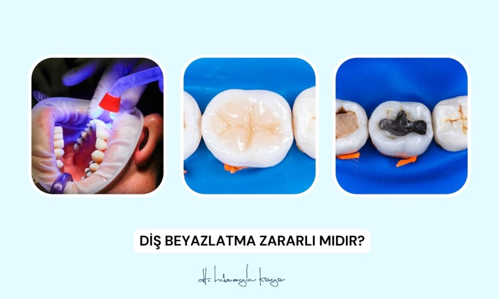 Siyah Dolgu Mu, Beyaz Dolgu Mu?