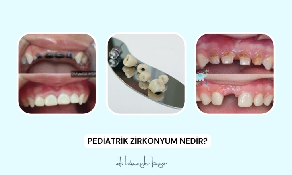 Pediatrik Zirkonyum Nedir?