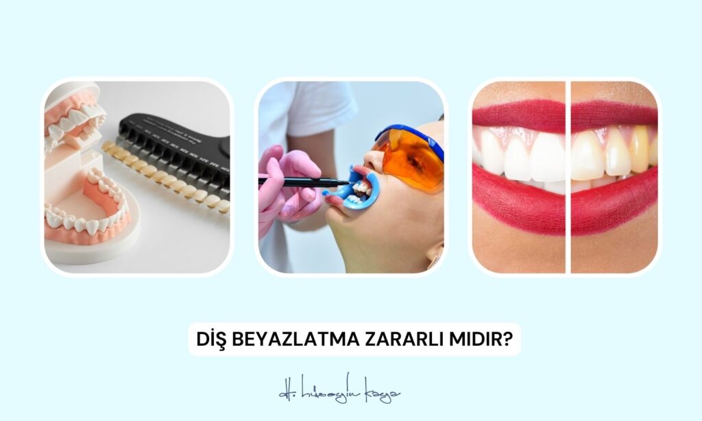 Diş Beyazlatma Zararlı Mıdır?