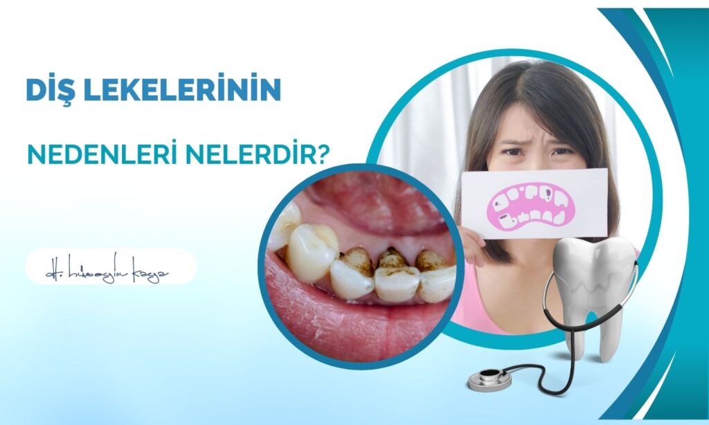 Diş Lekelerinin Nedenleri Nelerdir?