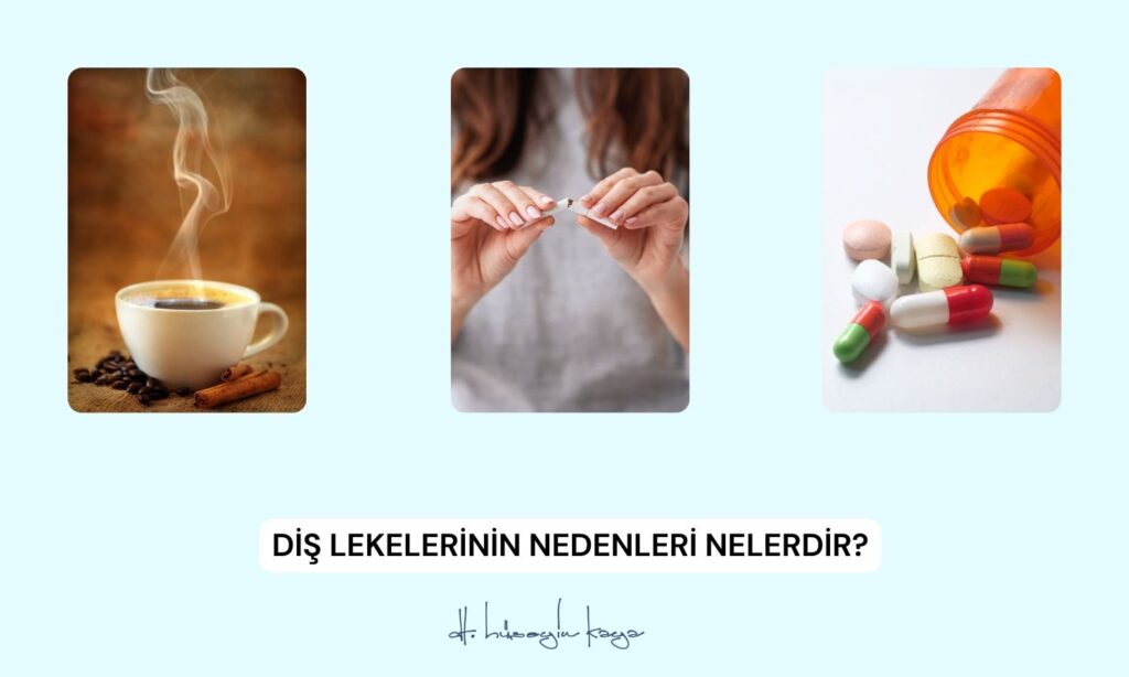 Diş Lekelerinin Nedenleri Nelerdir?