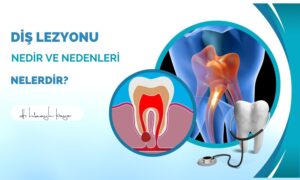 Diş Lezyonu Nedir ve Nedenleri Nelerdir?