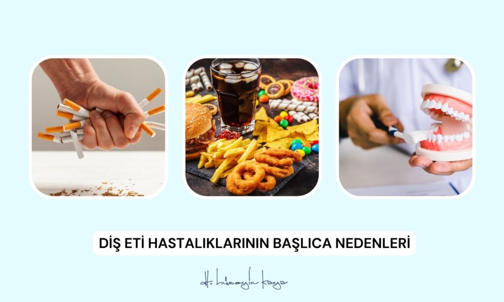 Diş Eti Hastalıklarının Başlıca Nedenleri