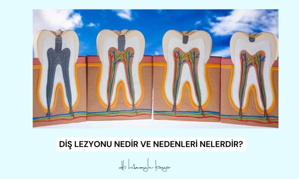 Diş Lezyonu Nedir ve Nedenleri Nelerdir?