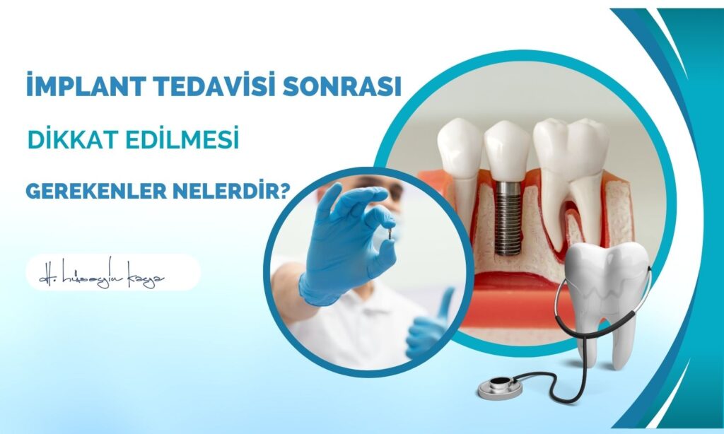 İmplant Tedavisi Sonrası Dikkat Edilmesi Gerekenler Nelerdir?