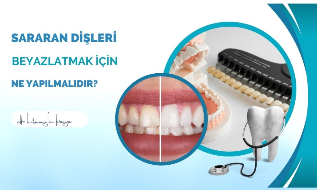 Sararan Dişleri Beyazlatmak İçin Ne Yapılmalıdır?