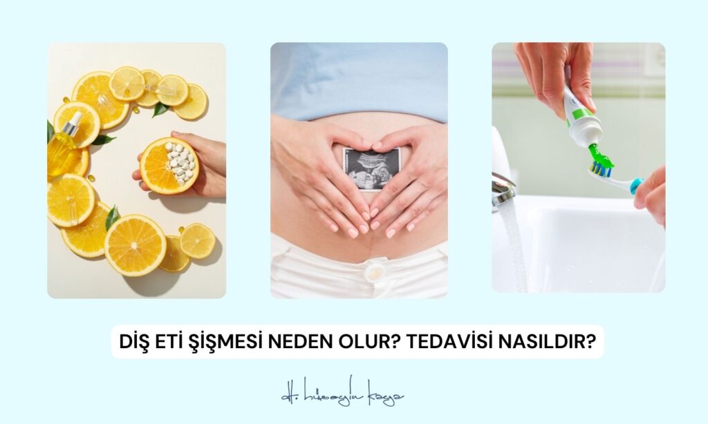 Diş Eti Şişmesi Neden Olur? Tedavisi Nasıldır?