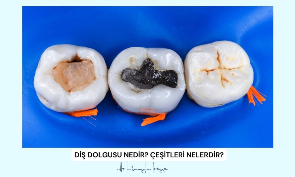 Diş Dolgusu Nedir? Çeşitleri Nelerdir?