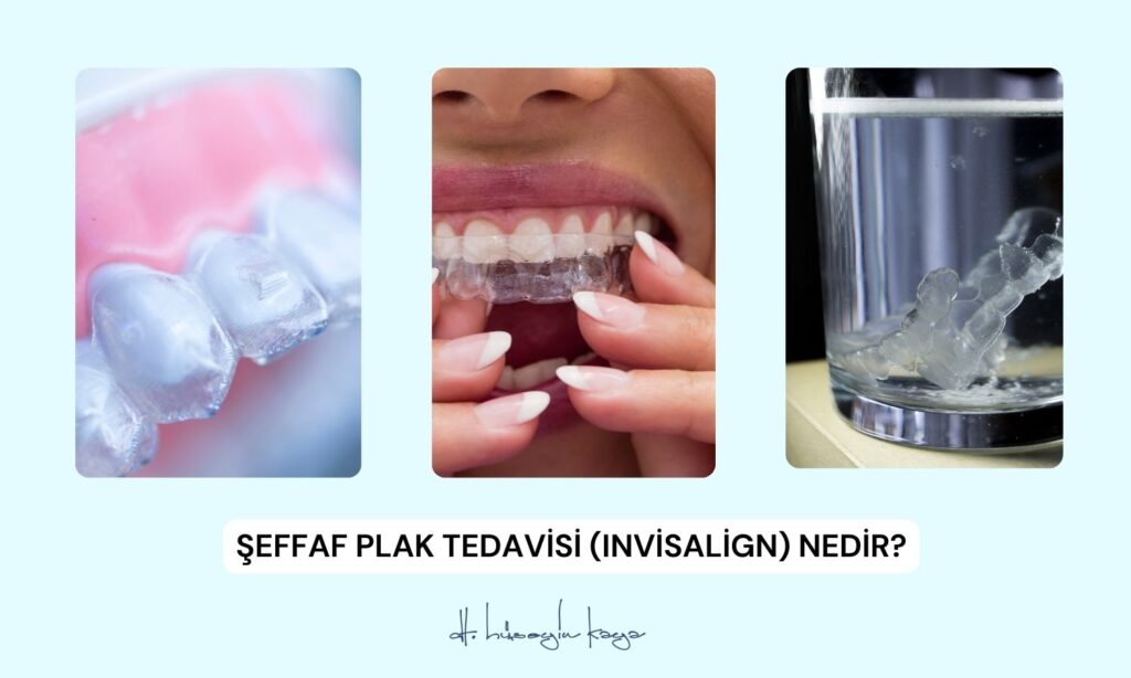 Şeffaf Plak Tedavisi (Invisalign) Nedir?