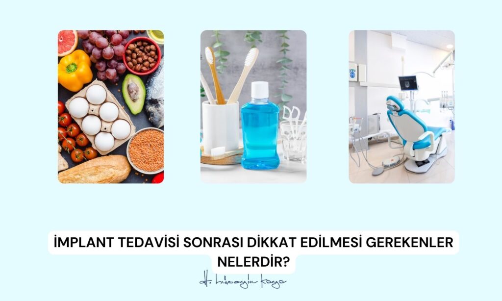 İmplant Tedavisi Sonrası Dikkat Edilmesi Gerekenler Nelerdir?