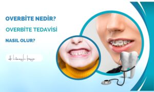 Overbite Nedir? Overbite Tedavisi Nasıl Olur?