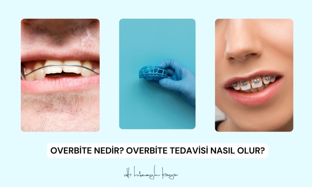 Overbite Nedir? Overbite Tedavisi Nasıl Olur?