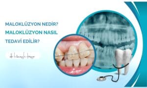 Maloklüzyon Nedir? Maloklüzyon Nasıl Tedavi Edilir?