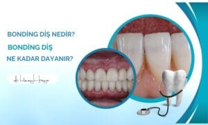 Bonding Diş Nedir? Bonding Diş Ne Kadar Dayanır?
