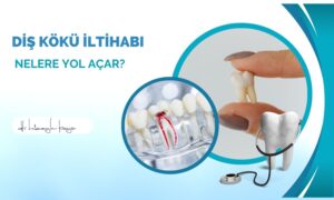 Diş Kökü İltihabı Nelere Yol Açar?
