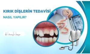 Kırık Dişlerin Tedavisi Nasıl Yapılır?