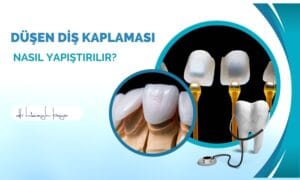 Düşen Diş Kaplaması Nasıl Yapıştırılır?