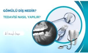 Gömülü Diş Nedir? Tedavisi Nasıl Yapılır?