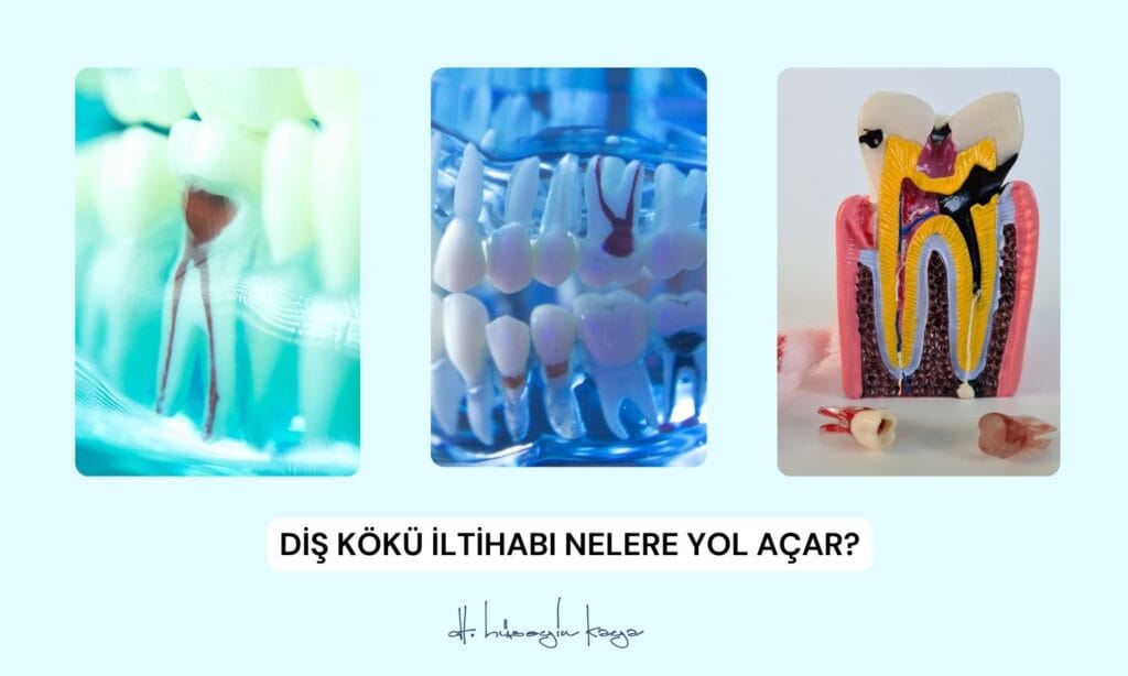 Diş Kökü İltihabı Nelere Yol Açar?