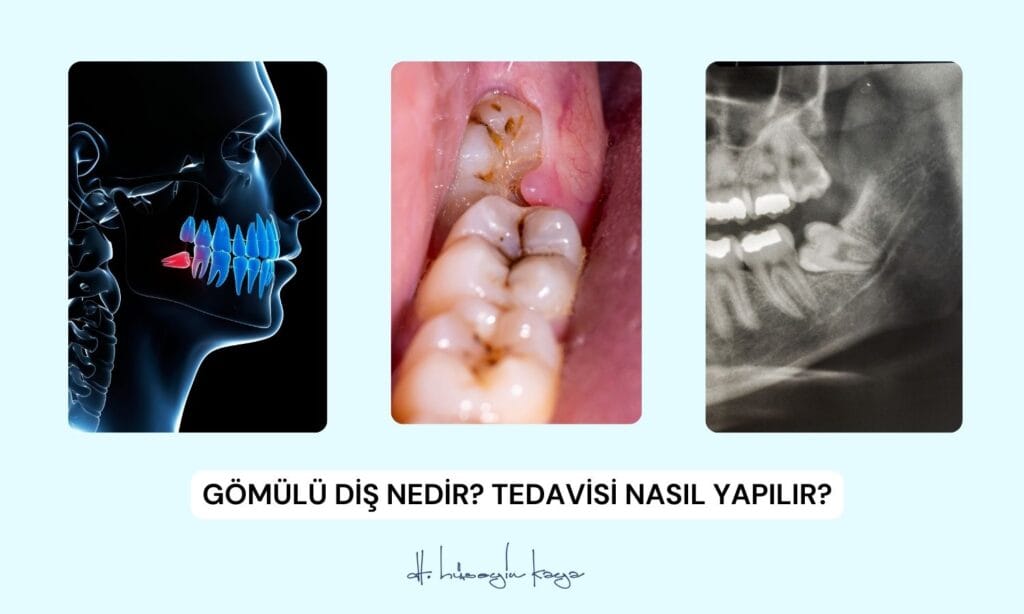 Gömülü Diş Nedir? Tedavisi Nasıl Yapılır?