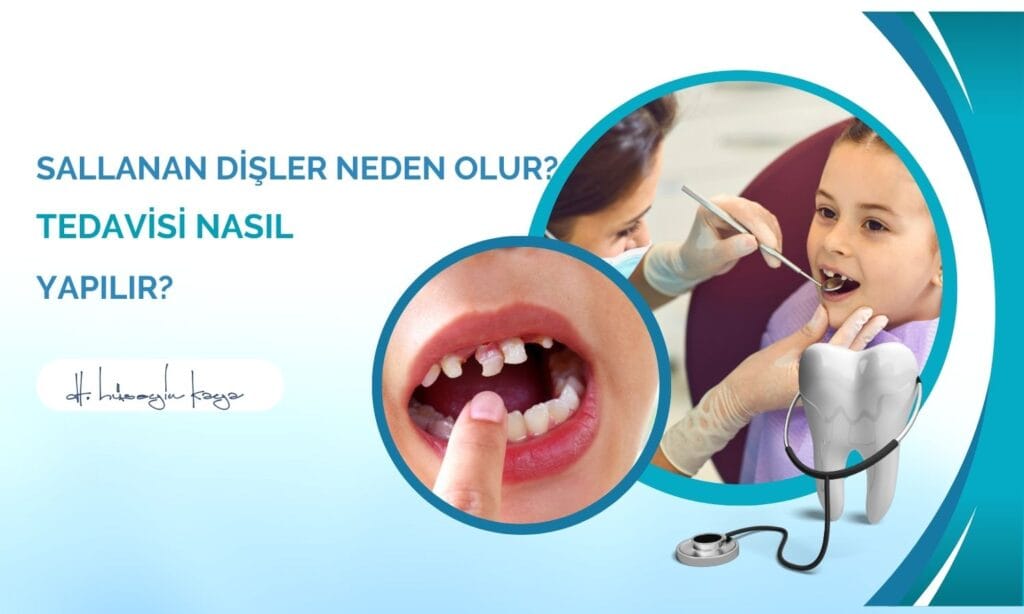 Sallanan Dişler Neden Olur? Tedavisi Nasıl Yapılır?