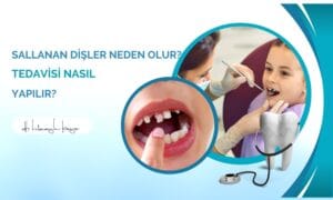 Sallanan Dişler Neden Olur? Tedavisi Nasıl Yapılır?
