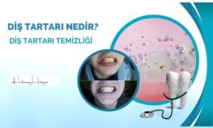 Diş Tartarı Nedir? Diş Tartarı Temizliği