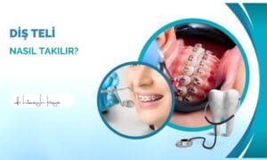 Diş Teli Nasıl Takılır?