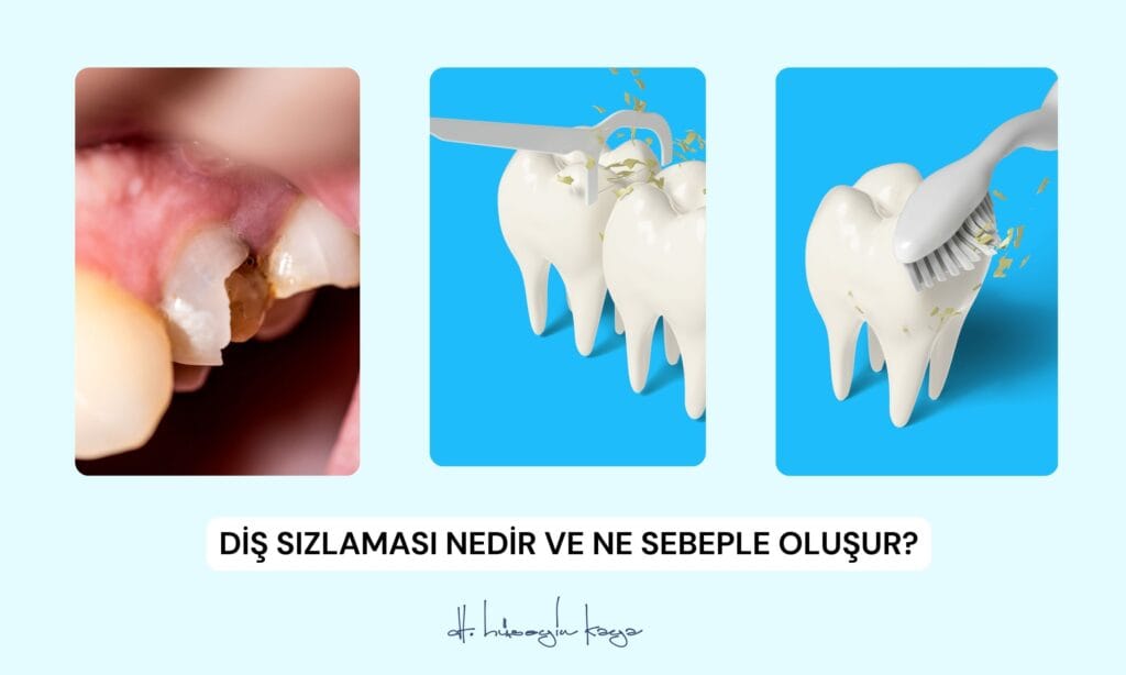 Diş Sızlaması Nedir ve Ne Sebeple Oluşur?