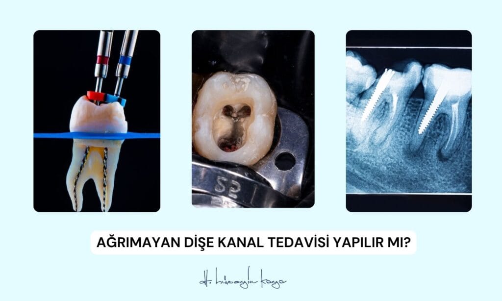 Ağrımayan Dişe Kanal Tedavisi Yapılır mı?