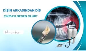 Dişin Arkasından Diş Çıkması Neden Olur?