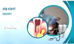 Diş Kisti Nedir?
