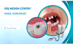 Diş Neden Çürür? Nasıl Korunur?