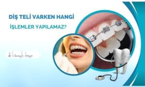 Diş Teli Varken Hangi İşlemler Yapılamaz?