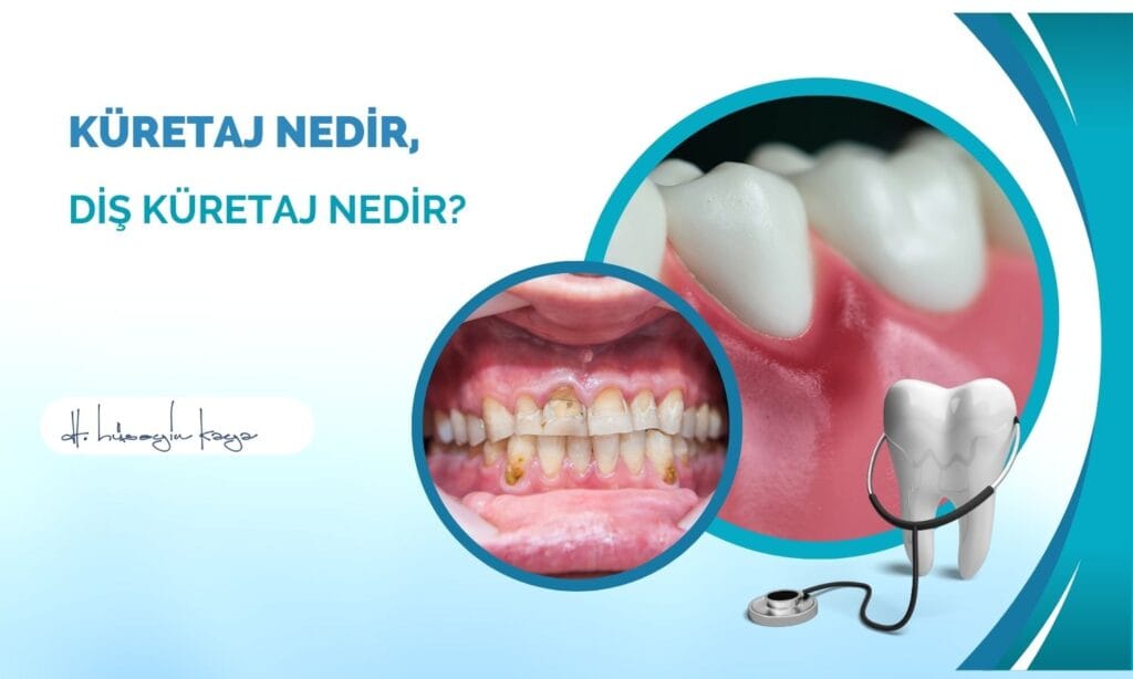 Küretaj Nedir, Diş Küretaj Nedir?