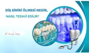 Diş Siniri Ölmesi Nedir, Nasıl Tedavi Edilir?