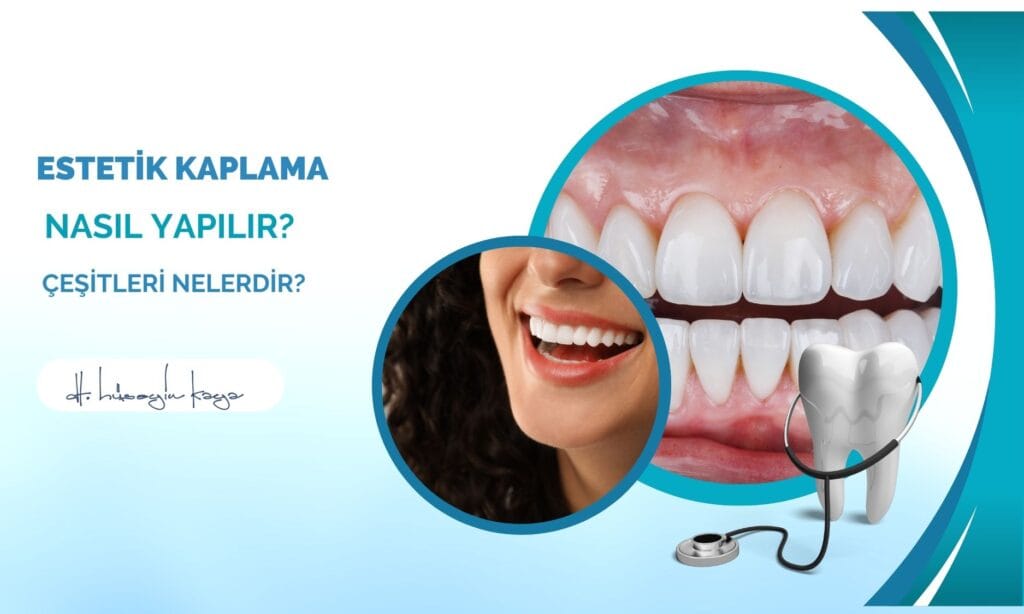 Estetik Kaplama Nasıl Yapılır? Çeşitleri Nelerdir?