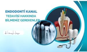 Endodonti Kanal Tedavisi Hakkında Bilmeniz Gerekenler