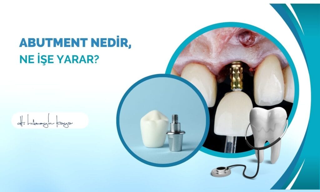 Abutment Nedir, Ne İşe Yarar?
