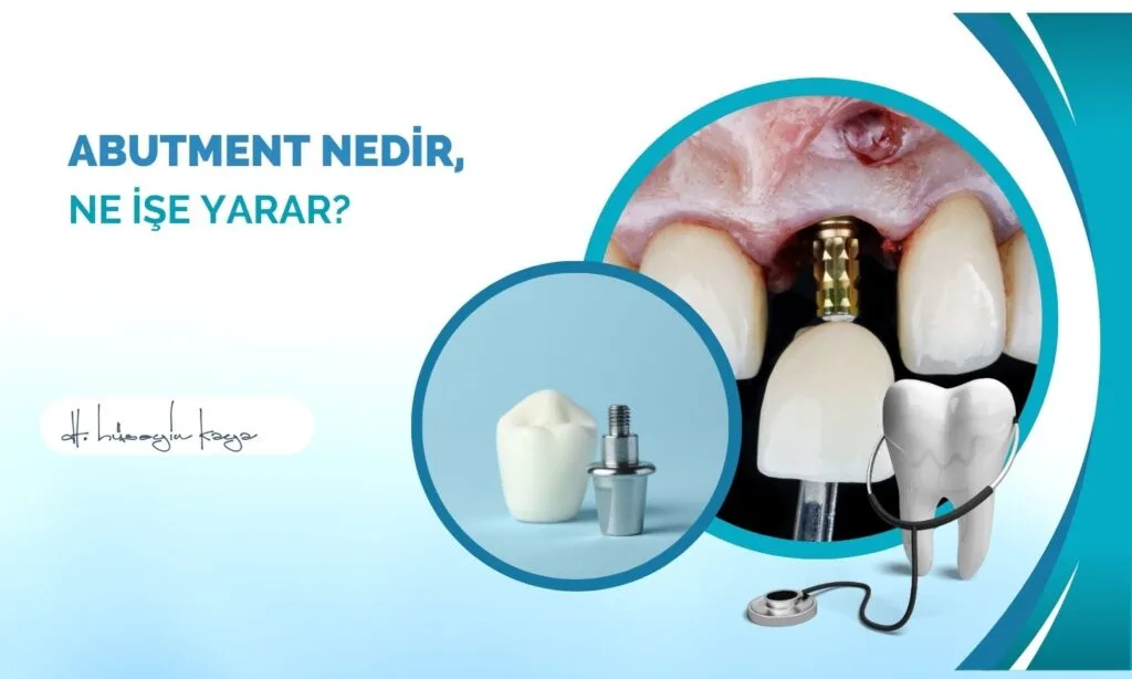 Abutment Nedir, Ne İşe Yarar?