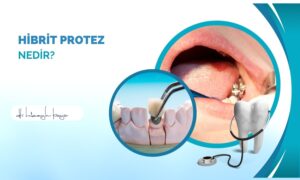 Hibrit Protez Nedir?