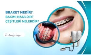 Braket Nedir? Bakımı Nasıldır? Çeşitleri Nelerdir?