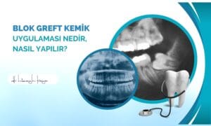 Blok Greft Kemik Uygulaması Nedir, Nasıl Yapılır?