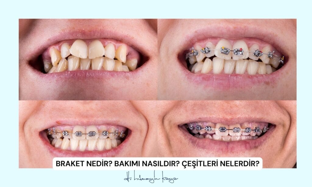Braket Nedir? Bakımı Nasıldır? Çeşitleri Nelerdir?
