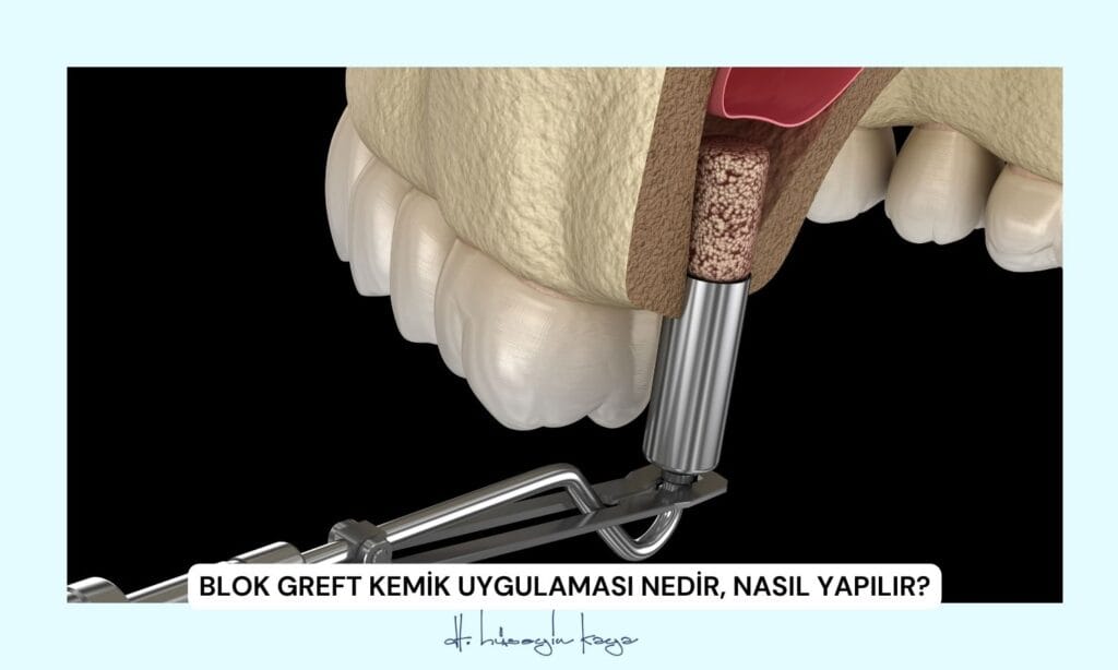 Blok Greft Kemik Uygulaması Nedir, Nasıl Yapılır?