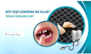 Süt Dişi Çürürse Ne Olur? Tedavi Edilmeli mi?